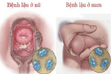 DẤU HIỆU BỆNH LẬU Ở NỮ – CHỮA BỆNH LẬU Ở NỮ KHỎI CHỈ CẦN 1 LIỆU TRÌNH